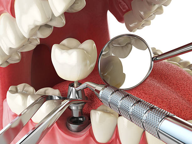 Teeth Whitening in GA
